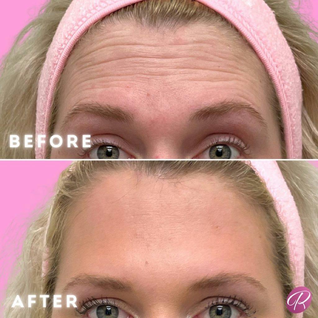Juvederm Before & After Gallery - Patient 86641288 - Image 1