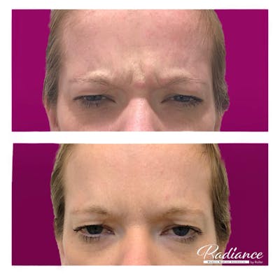 BOTOX Cosmetic Before & After Gallery - Patient 86641290 - Image 1