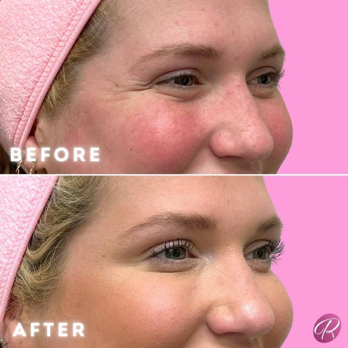 Juvederm Before & After Gallery - Patient 86641288 - Image 2