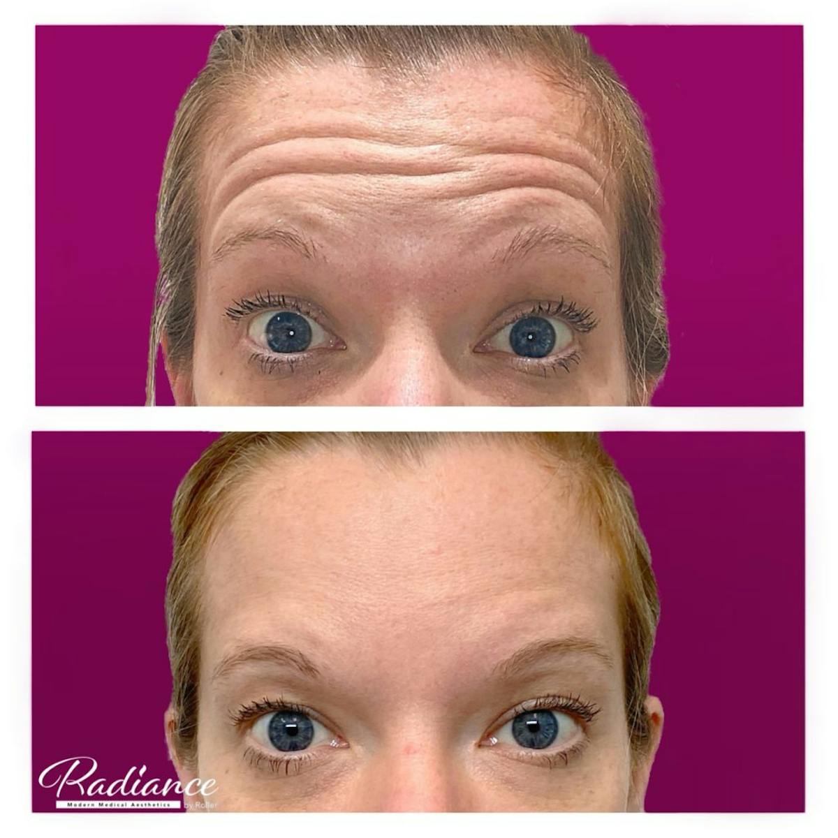 BOTOX Cosmetic Before & After Gallery - Patient 86641290 - Image 2