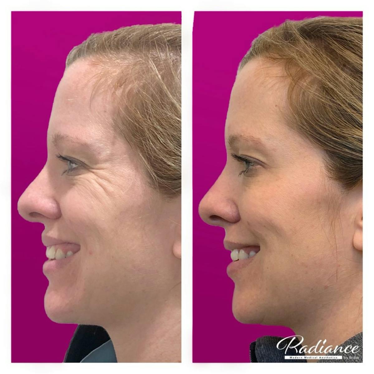 BOTOX Cosmetic Before & After Gallery - Patient 86641290 - Image 3