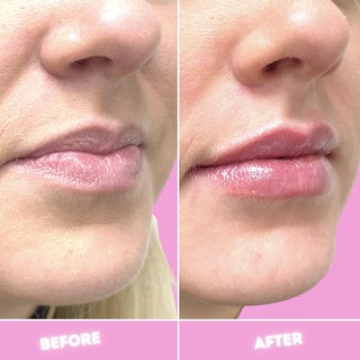 Juvederm Before & After Gallery - Patient 86641306 - Image 1