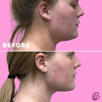 FaceTite Before & After Gallery - Patient 86641313 - Image 1