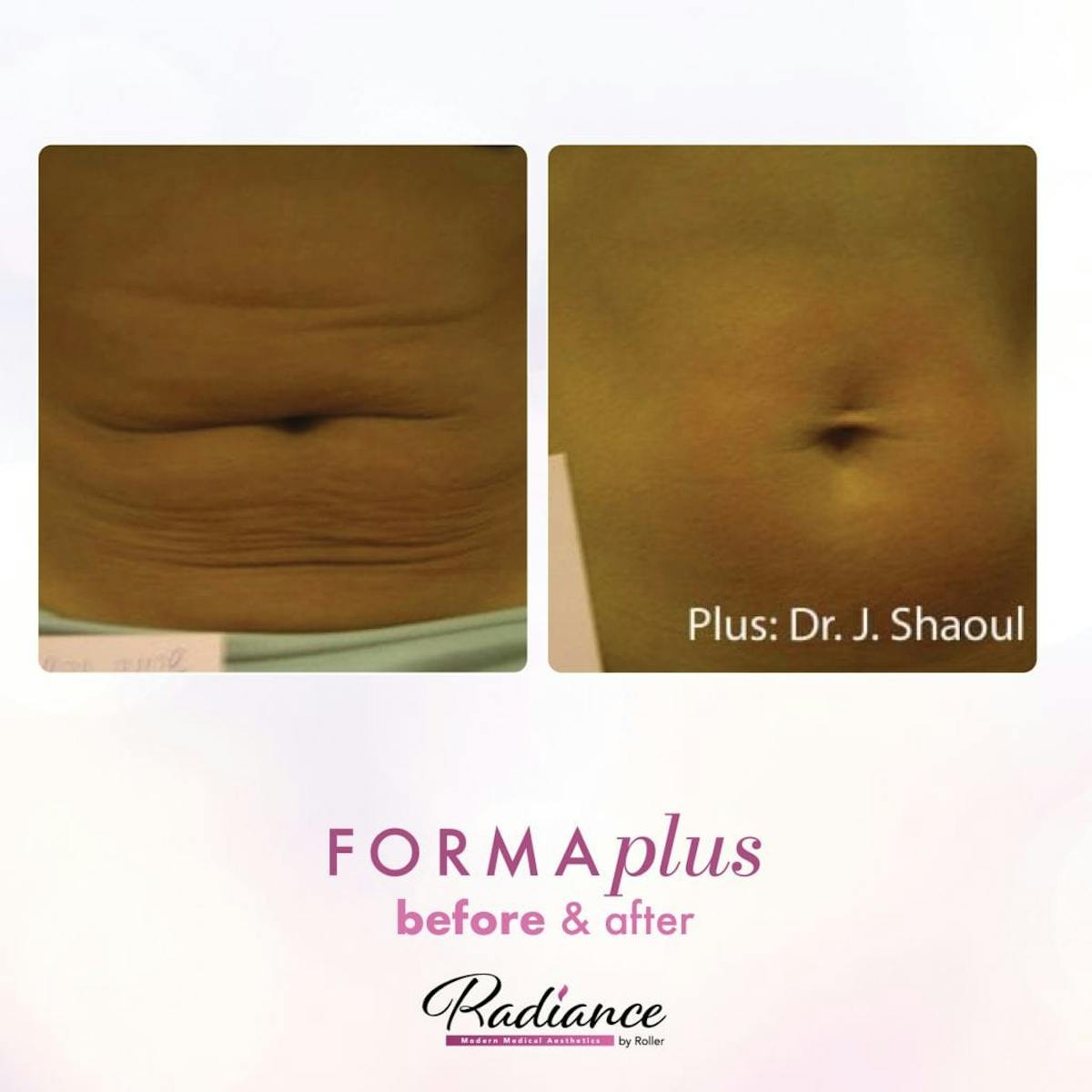 FormaPlus Before & After Gallery - Patient 86641312 - Image 1