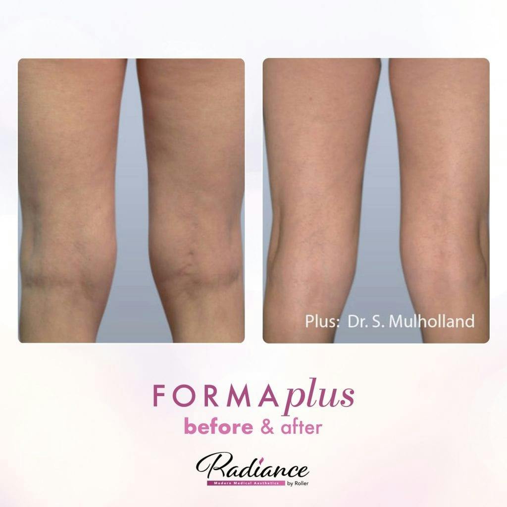 FormaPlus Before & After Gallery - Patient 86641314 - Image 1