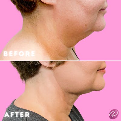 FaceTite Before & After Gallery - Patient 86641317 - Image 1