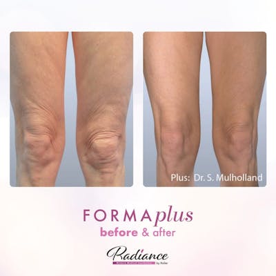 FormaPlus Before & After Gallery - Patient 86641316 - Image 1