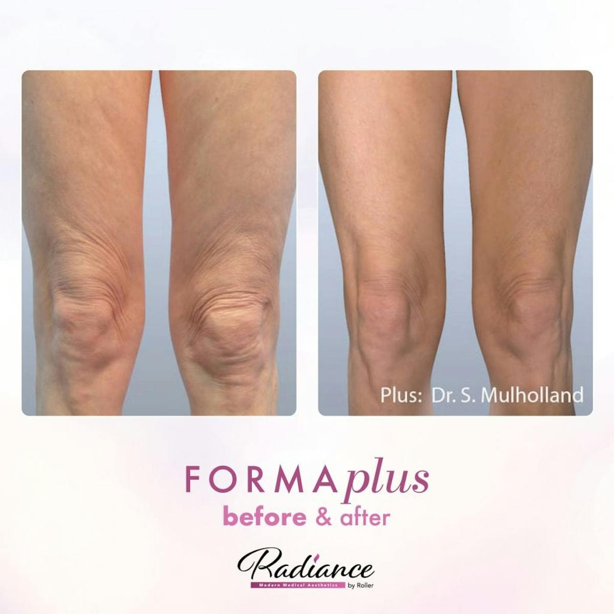 FormaPlus Before & After Gallery - Patient 86641316 - Image 1