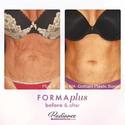 FormaPlus Before & After Gallery - Patient 86641319 - Image 1