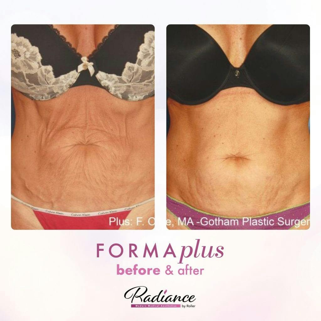 FormaPlus Before & After Gallery - Patient 86641319 - Image 1