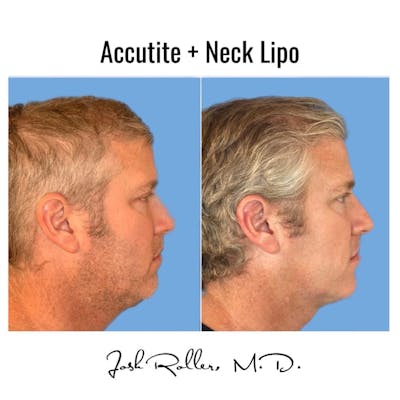 Accutite Before & After Gallery - Patient 86641322 - Image 1