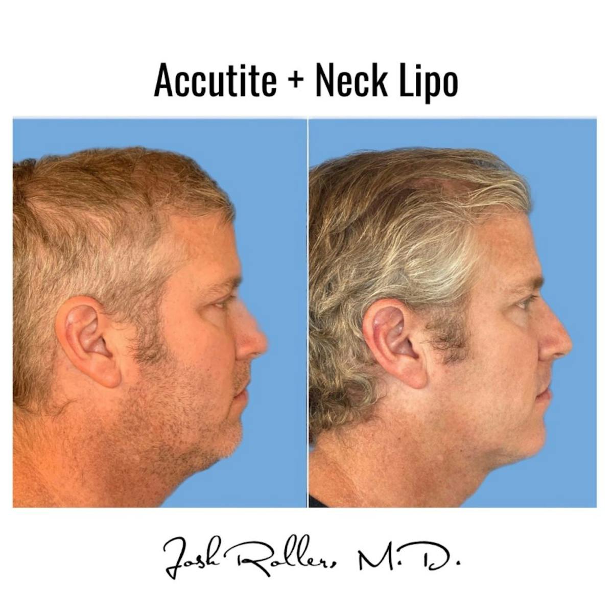 Accutite Before & After Gallery - Patient 86641322 - Image 1