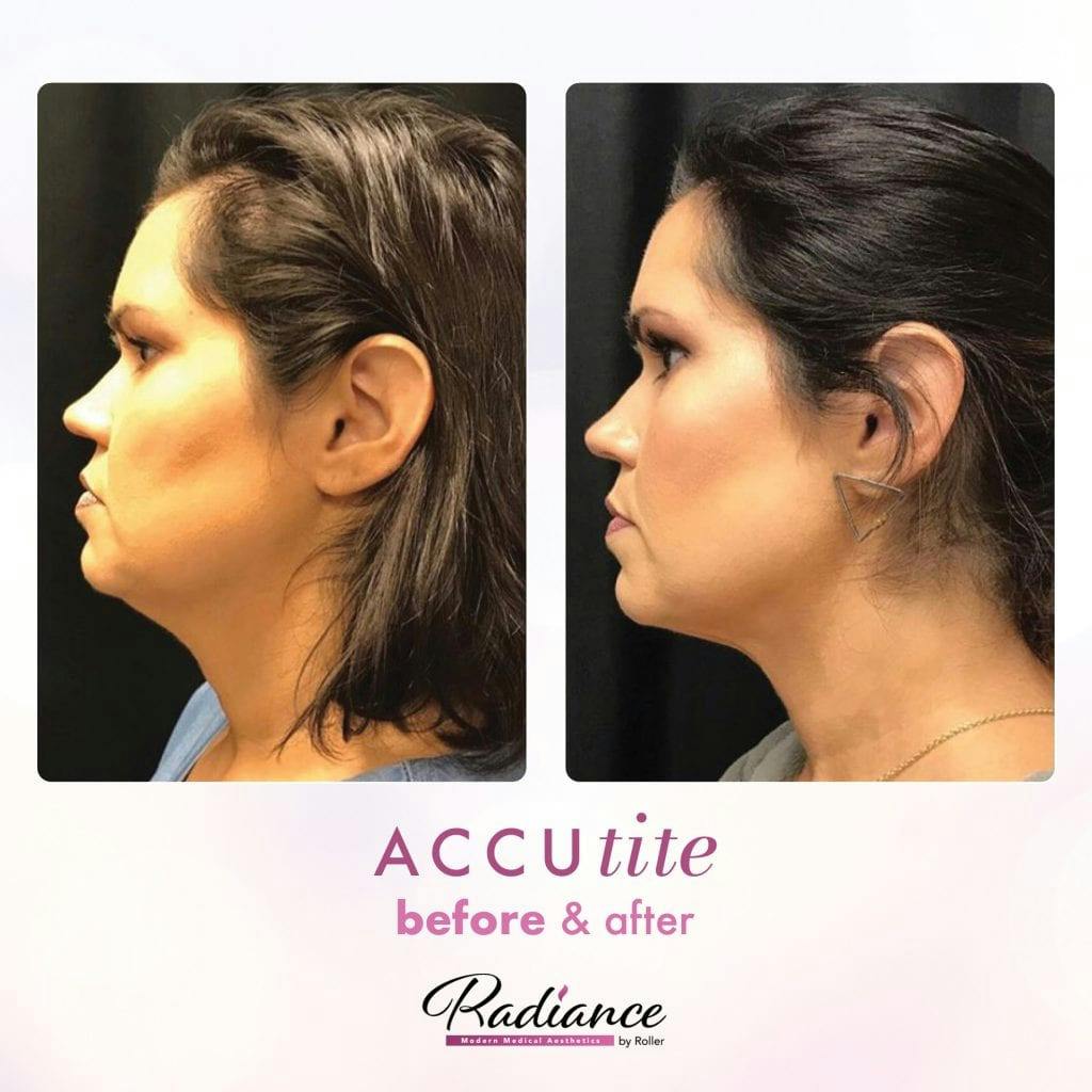 Accutite Before & After Gallery - Patient 86641325 - Image 1