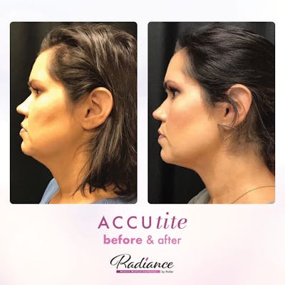 Accutite Before & After Gallery - Patient 86641325 - Image 1