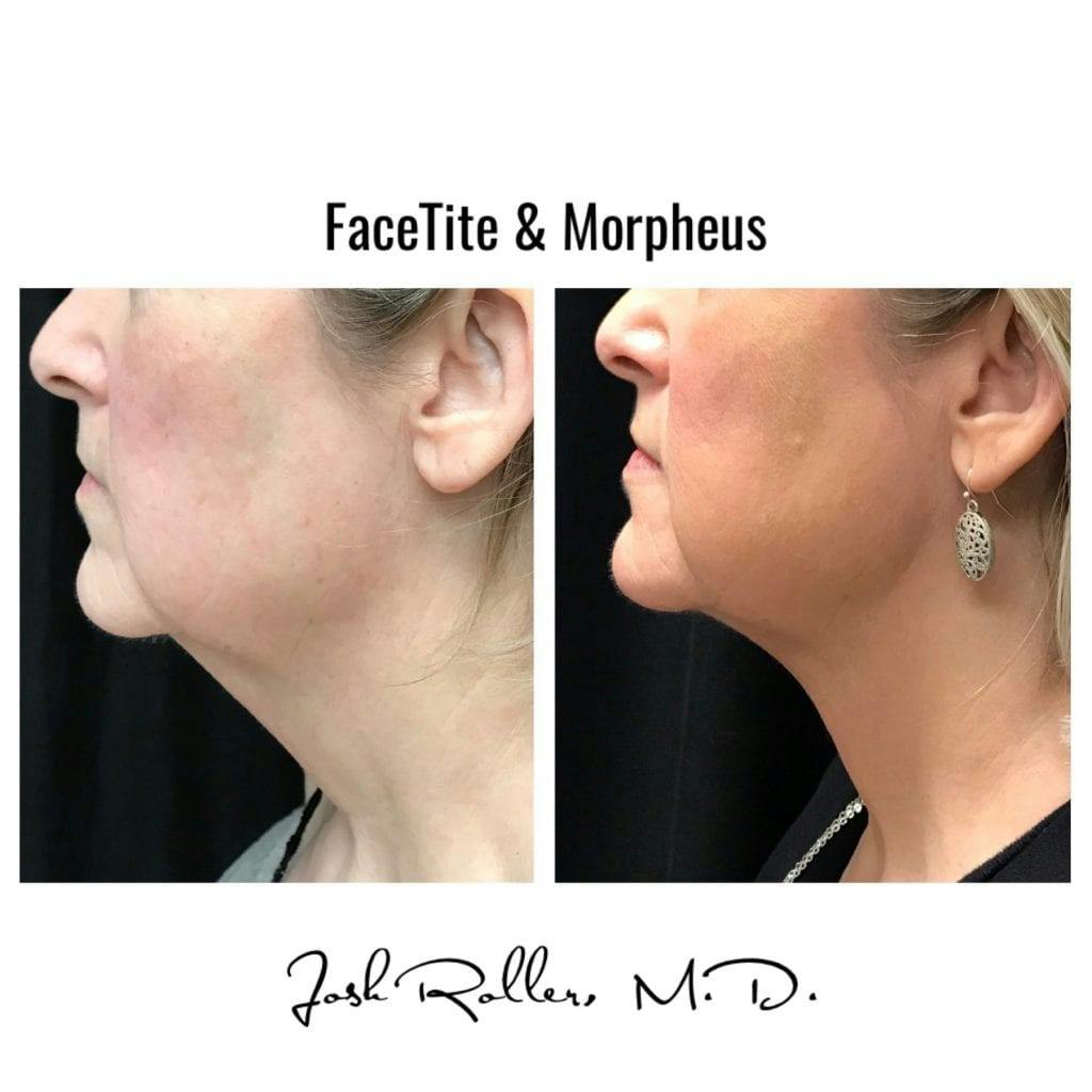 Morpheus8 Before & After Gallery - Patient 86641327 - Image 1