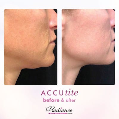 Accutite Before & After Gallery - Patient 86641328 - Image 1