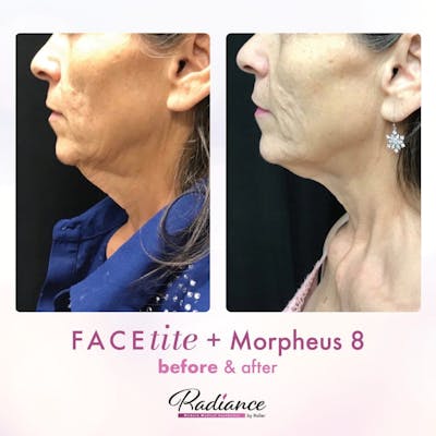 Morpheus8 Before & After Gallery - Patient 86641333 - Image 1