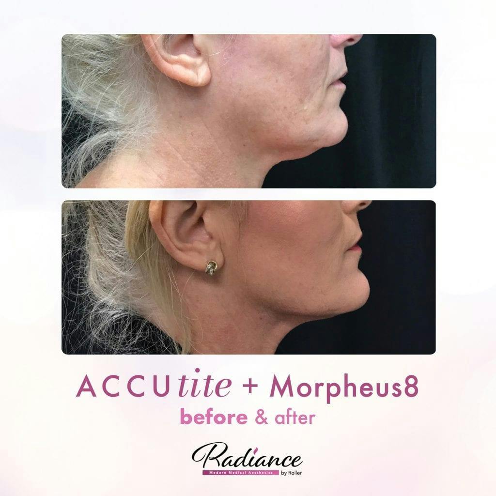 Accutite Before & After Gallery - Patient 86641335 - Image 1