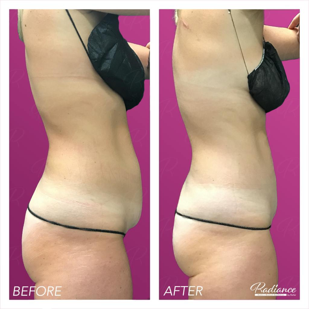 BodyTite Before & After Gallery - Patient 86641339 - Image 2
