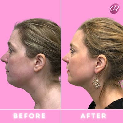 FaceTite Before & After Gallery - Patient 86641346 - Image 1