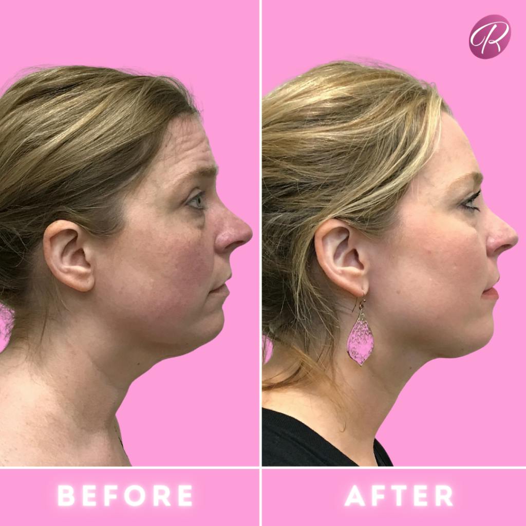 FaceTite Before & After Gallery - Patient 86641346 - Image 2