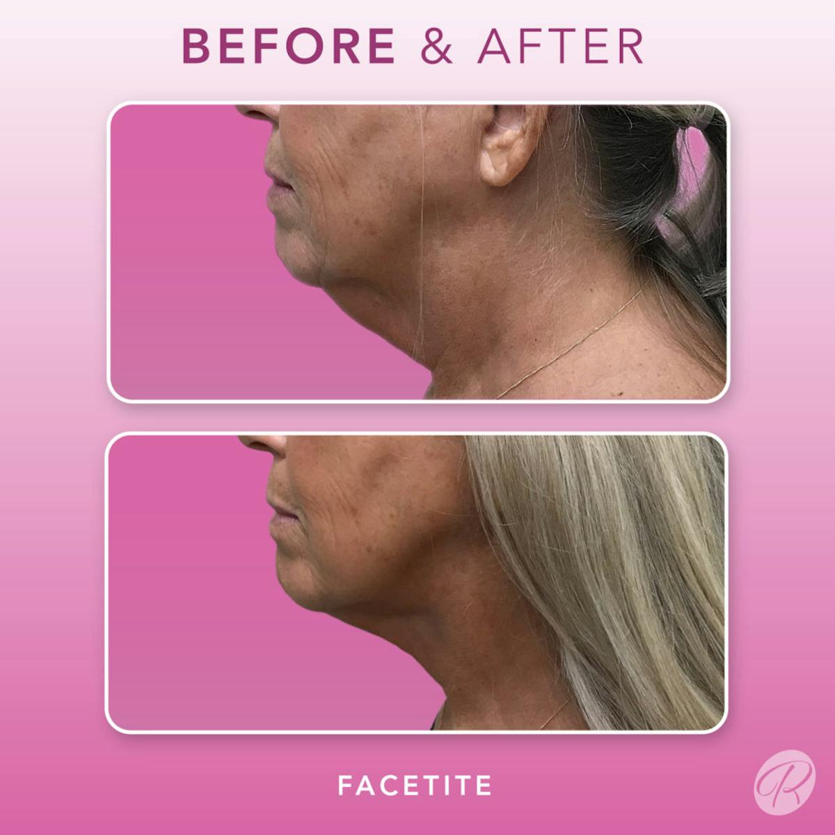 FaceTite Before & After Gallery - Patient 86641356 - Image 1