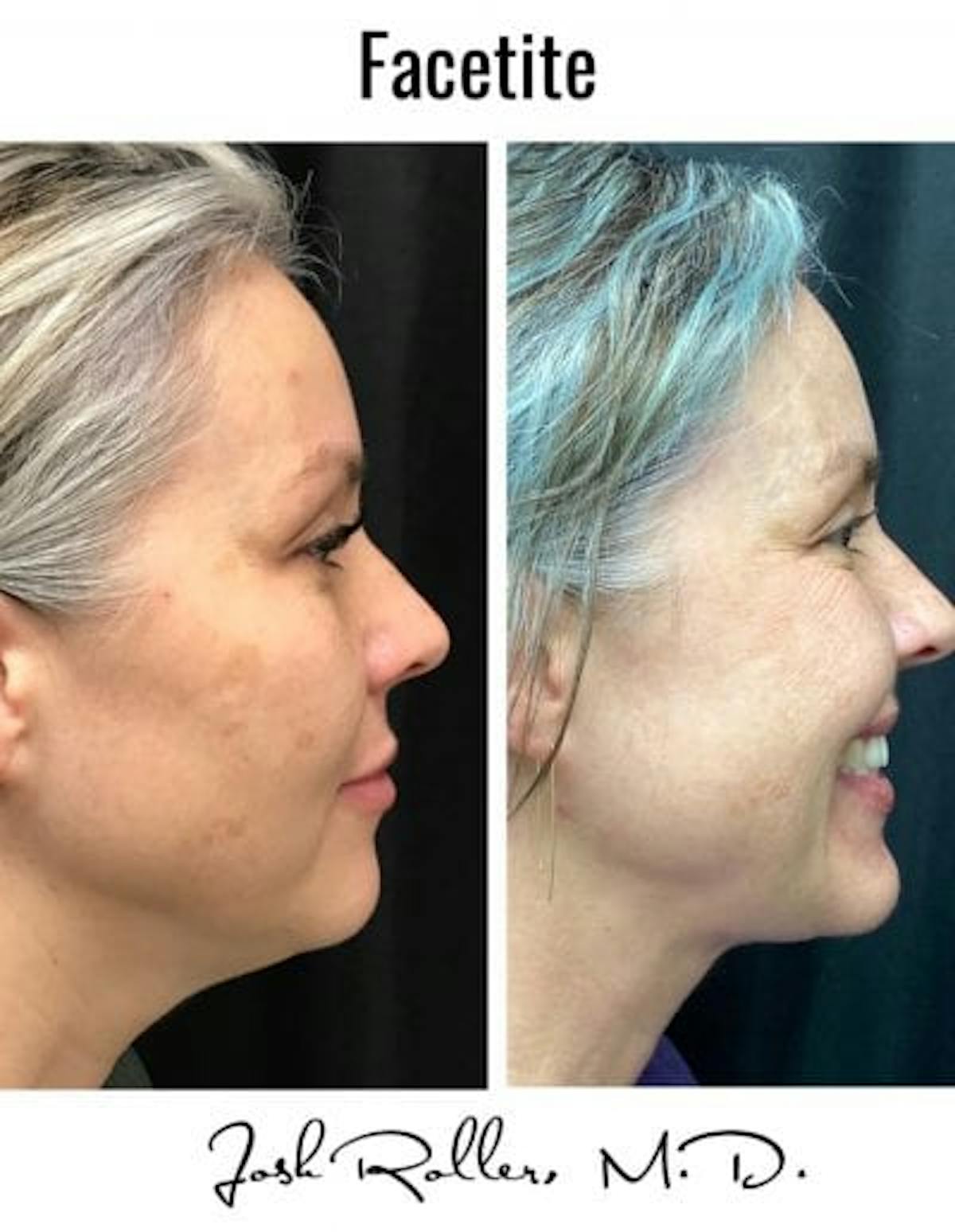 FaceTite Before & After Gallery - Patient 86641358 - Image 1