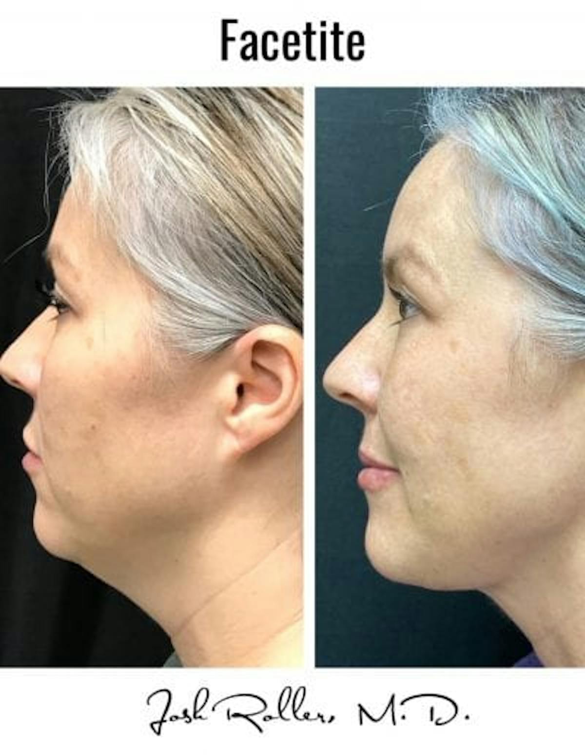 FaceTite Before & After Gallery - Patient 86641358 - Image 2