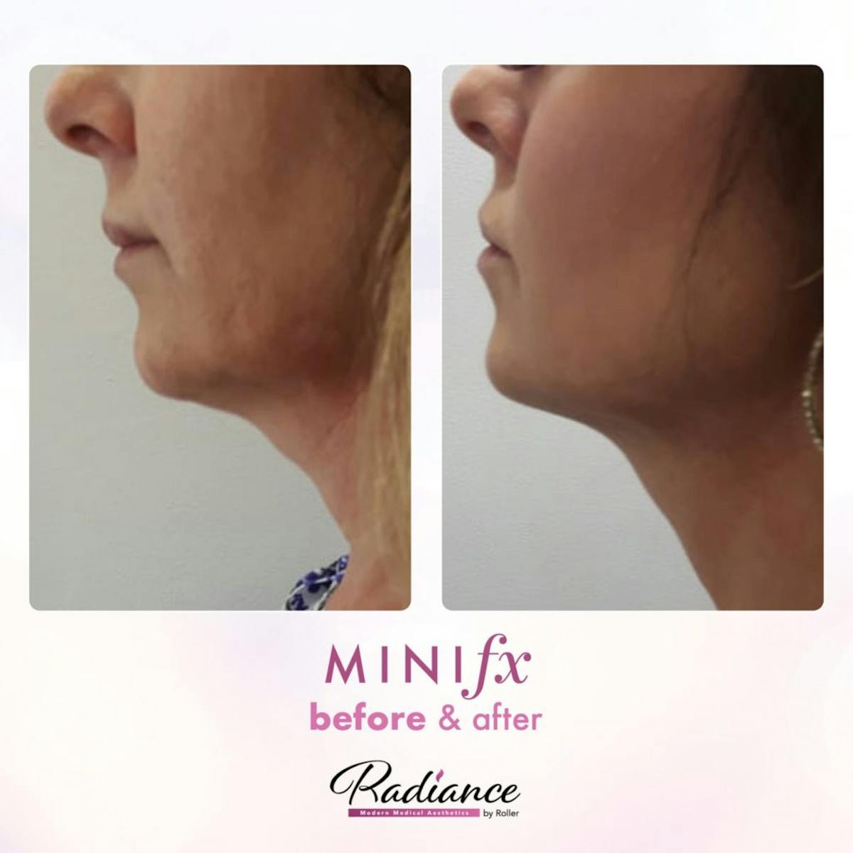 MiniFx Before & After Gallery - Patient 86641363 - Image 1
