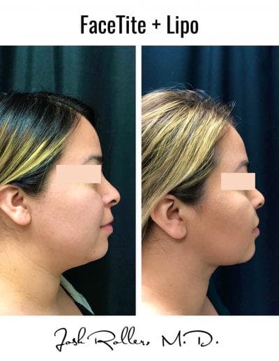 FaceTite Before & After Gallery - Patient 86641365 - Image 1