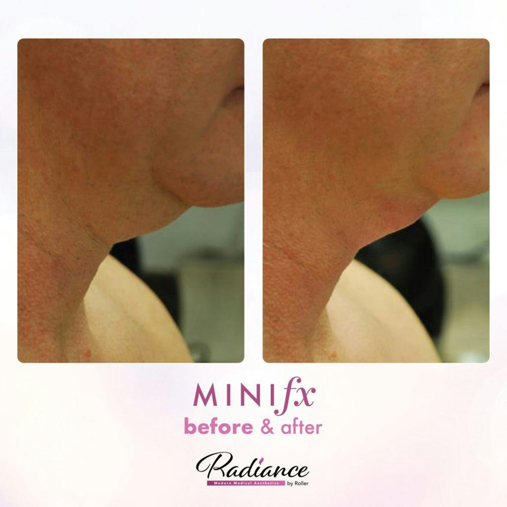 MiniFx Before & After Gallery - Patient 86641366 - Image 1