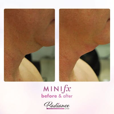 MiniFx Before & After Gallery - Patient 86641366 - Image 1