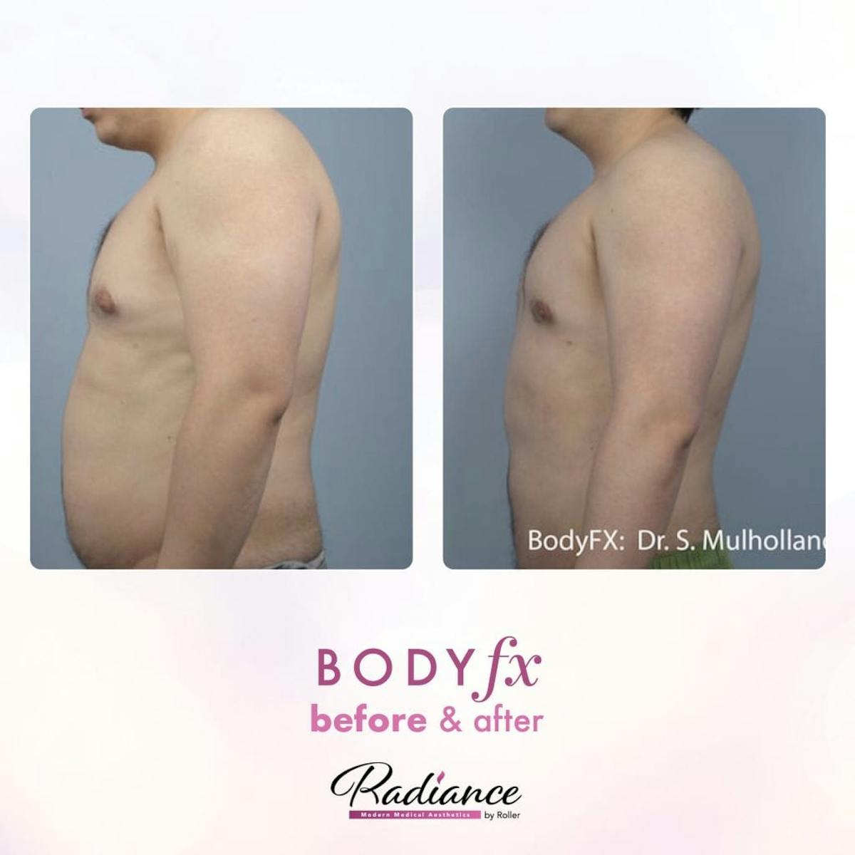 BodyFx Before & After Gallery - Patient 86641369 - Image 1