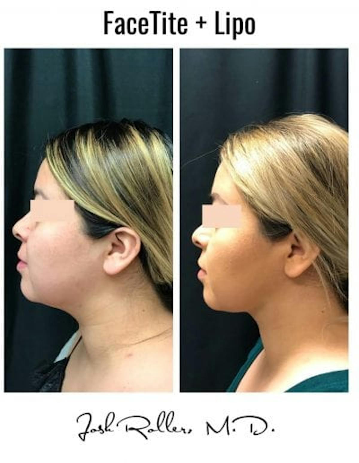 FaceTite Before & After Gallery - Patient 86641365 - Image 2