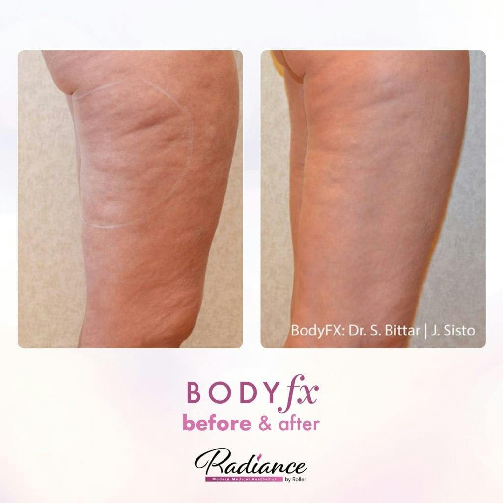 BodyFx Before & After Gallery - Patient 86641371 - Image 1