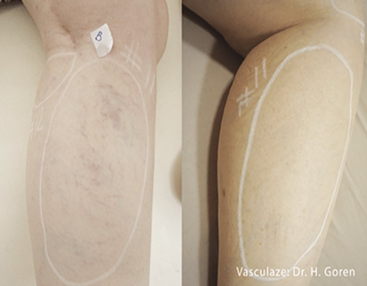 Vasculaze Before & After Gallery - Patient 86641373 - Image 1