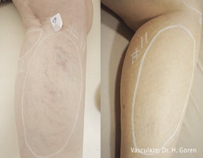 Vasculaze Before & After Gallery - Patient 86641373 - Image 1