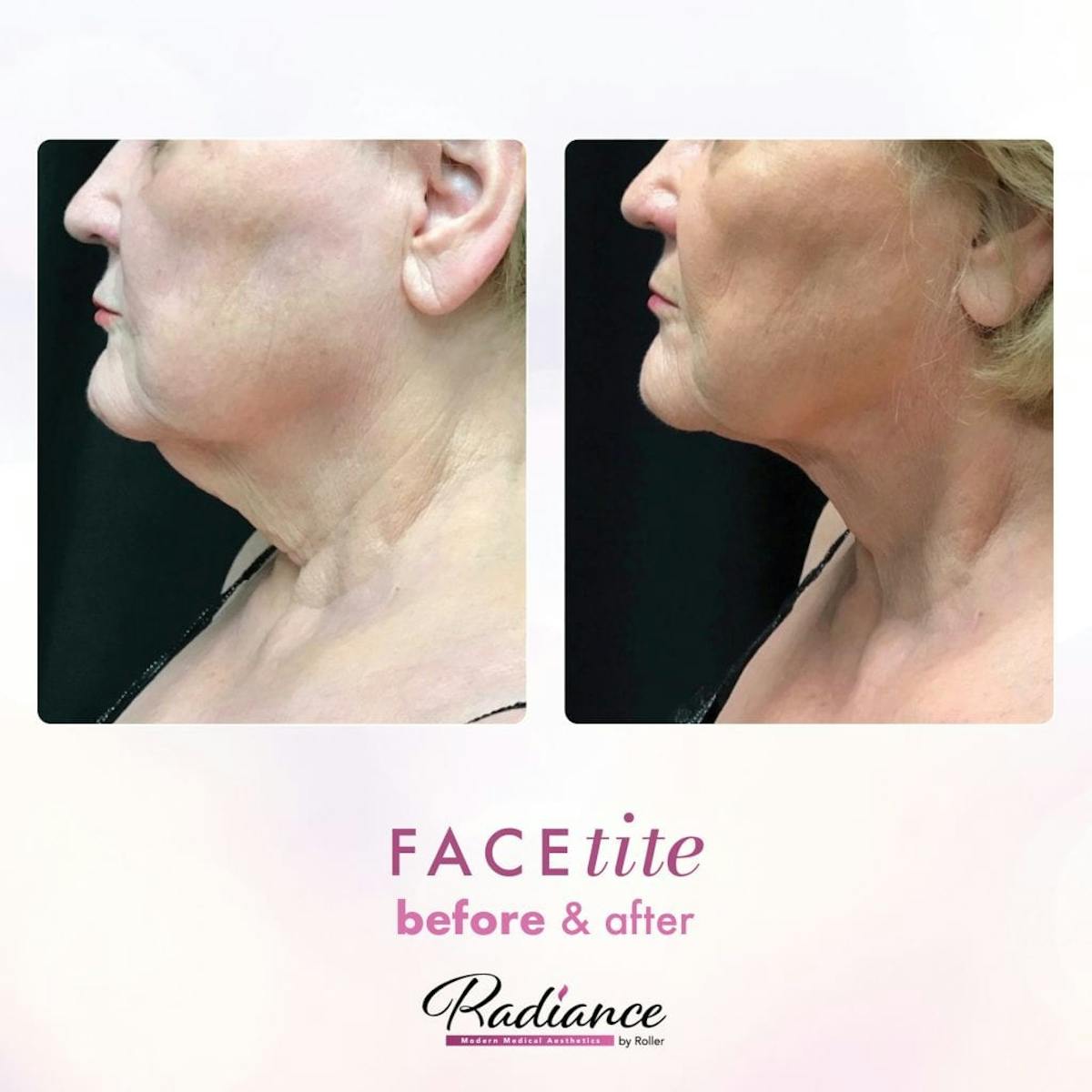FaceTite Before & After Gallery - Patient 86641372 - Image 1