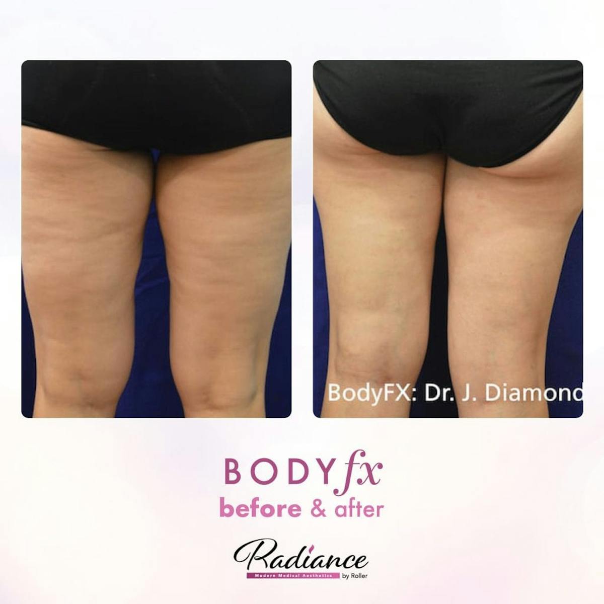 BodyFx Before & After Gallery - Patient 86641376 - Image 1