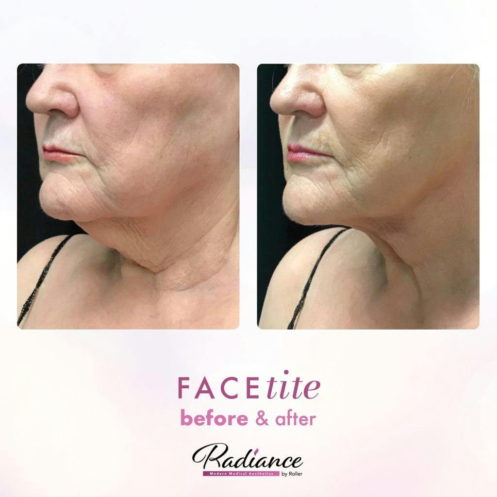 FaceTite Before & After Gallery - Patient 86641372 - Image 2