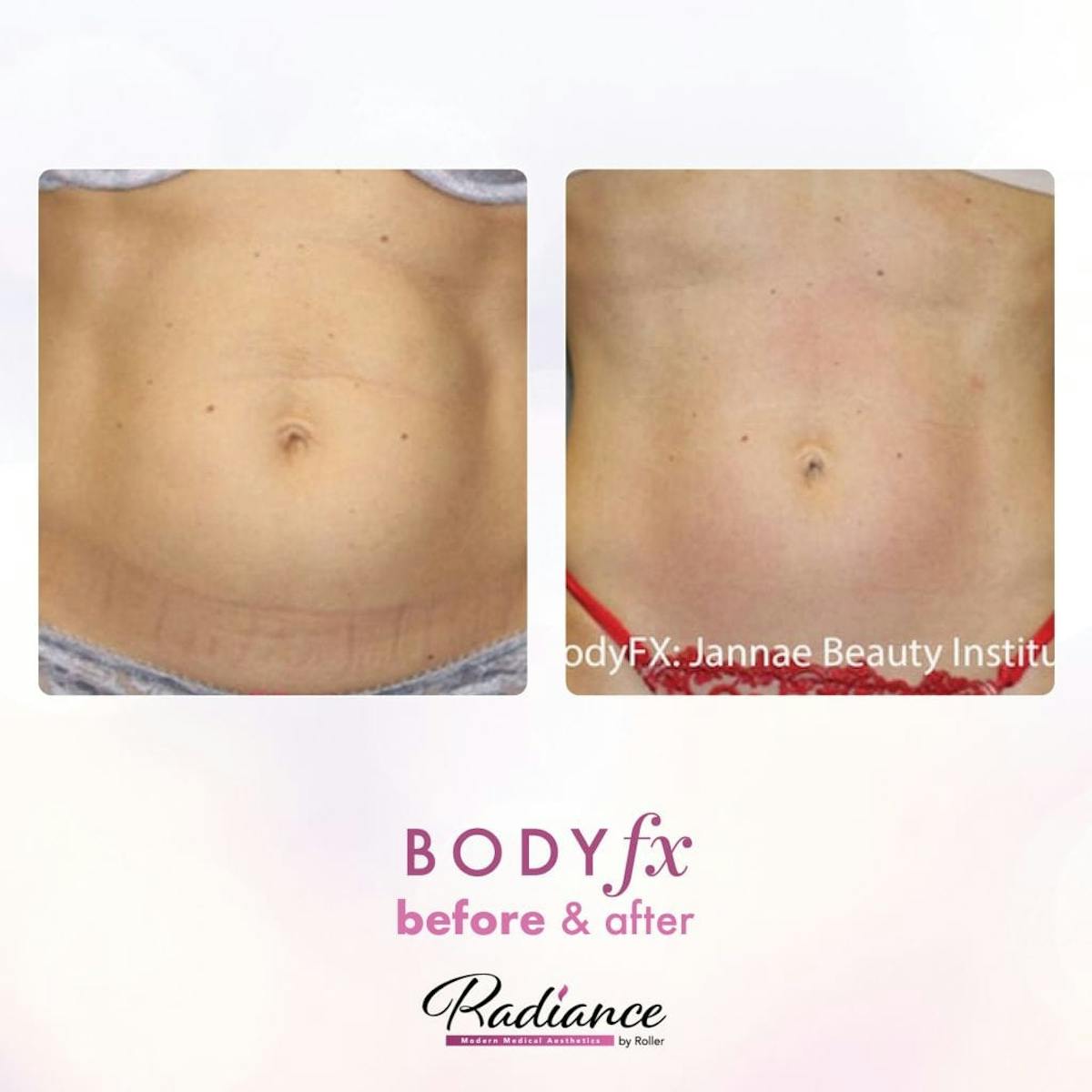 BodyFx Before & After Gallery - Patient 86641382 - Image 1
