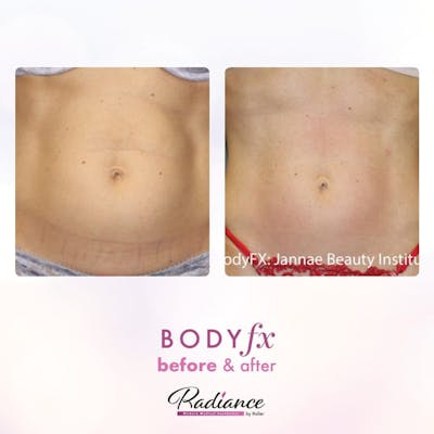 BodyFx Before & After Gallery - Patient 86641382 - Image 1