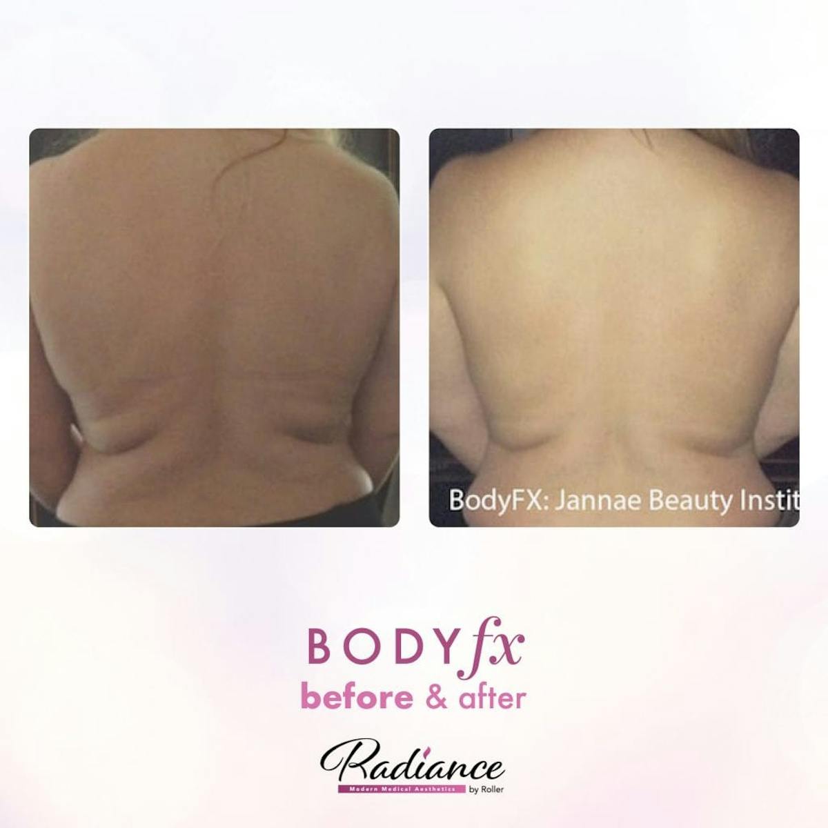 BodyFx Before & After Gallery - Patient 86641387 - Image 1