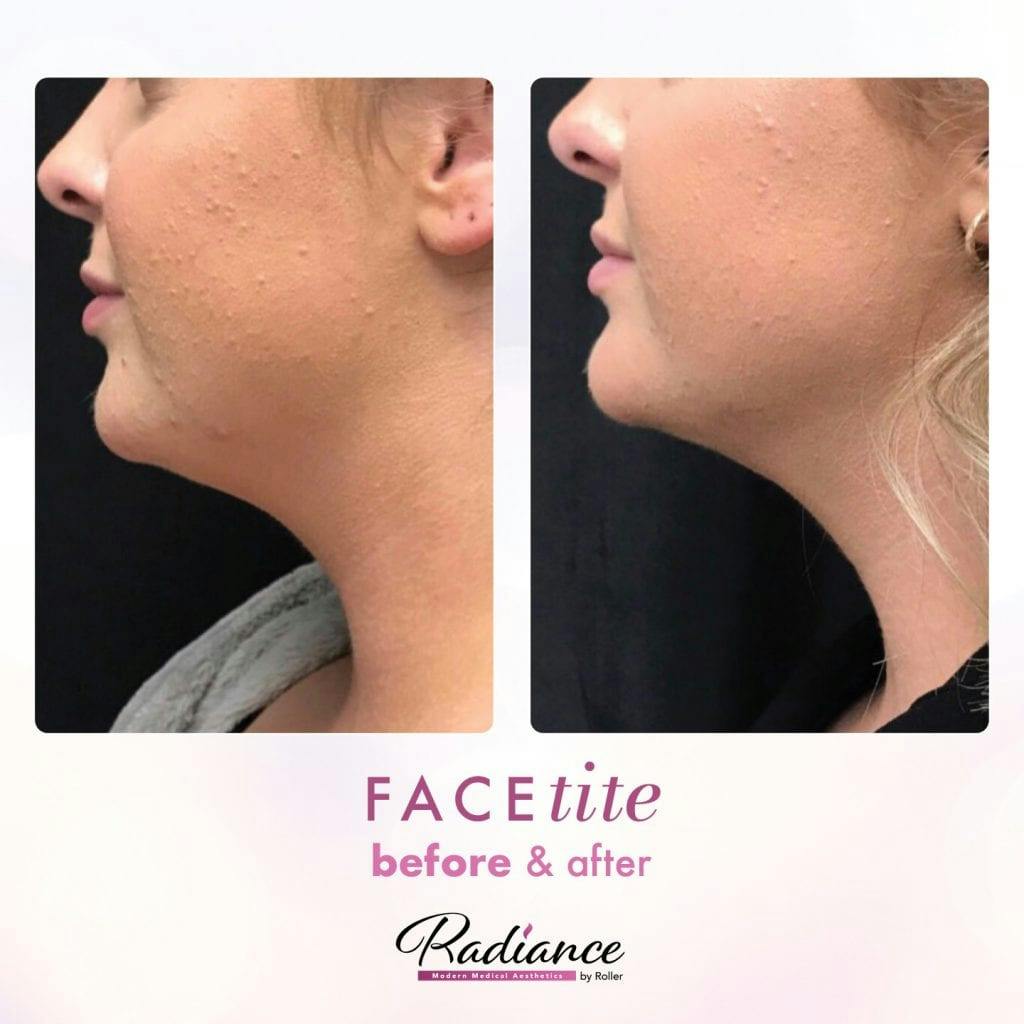 FaceTite Before & After Gallery - Patient 86641388 - Image 1