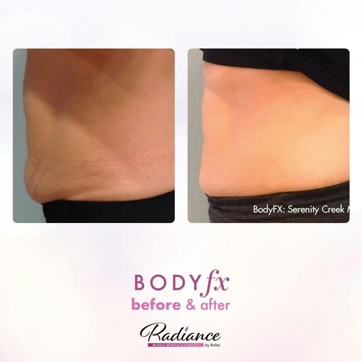 BodyFx Before & After Gallery - Patient 86641391 - Image 1