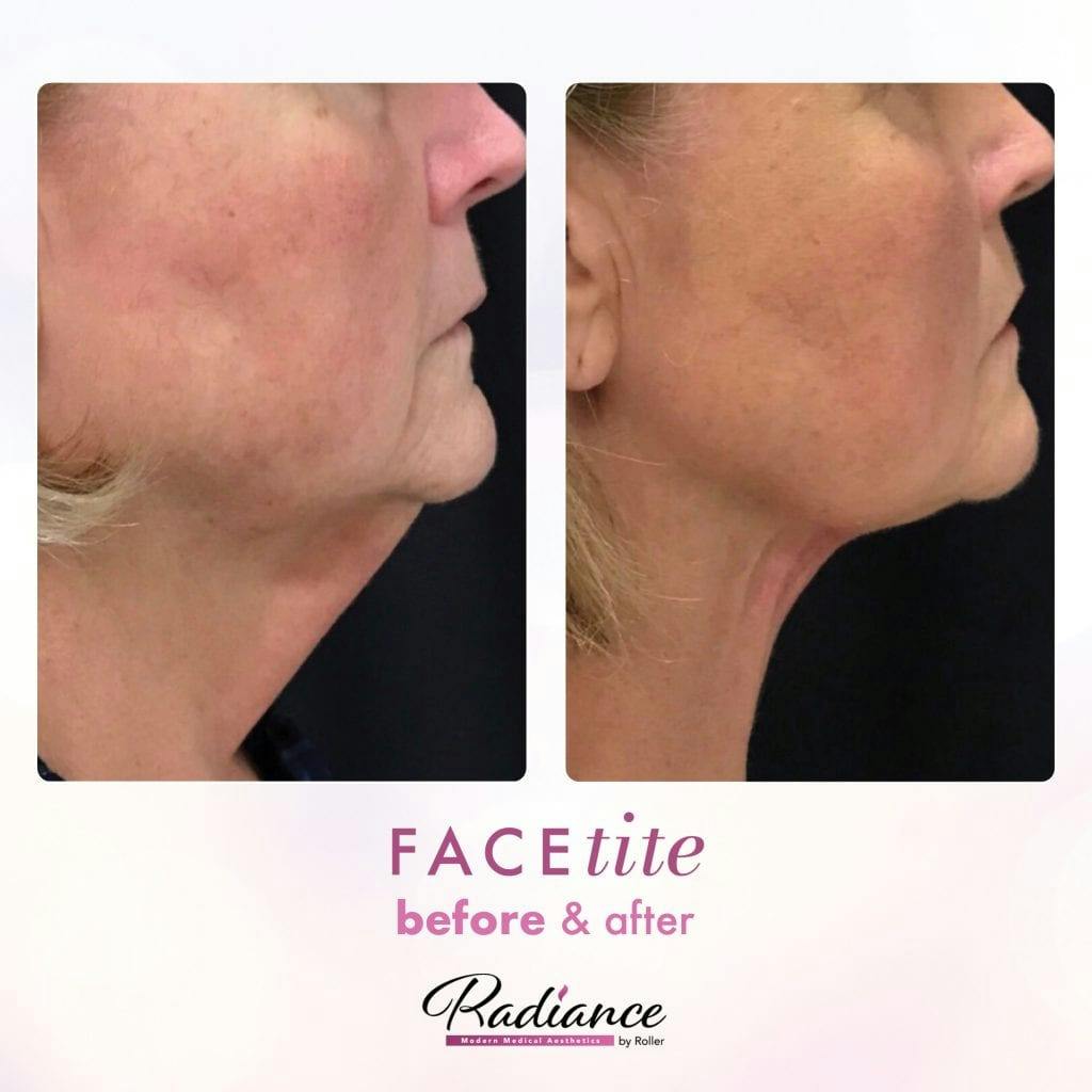FaceTite Before & After Gallery - Patient 86641392 - Image 1