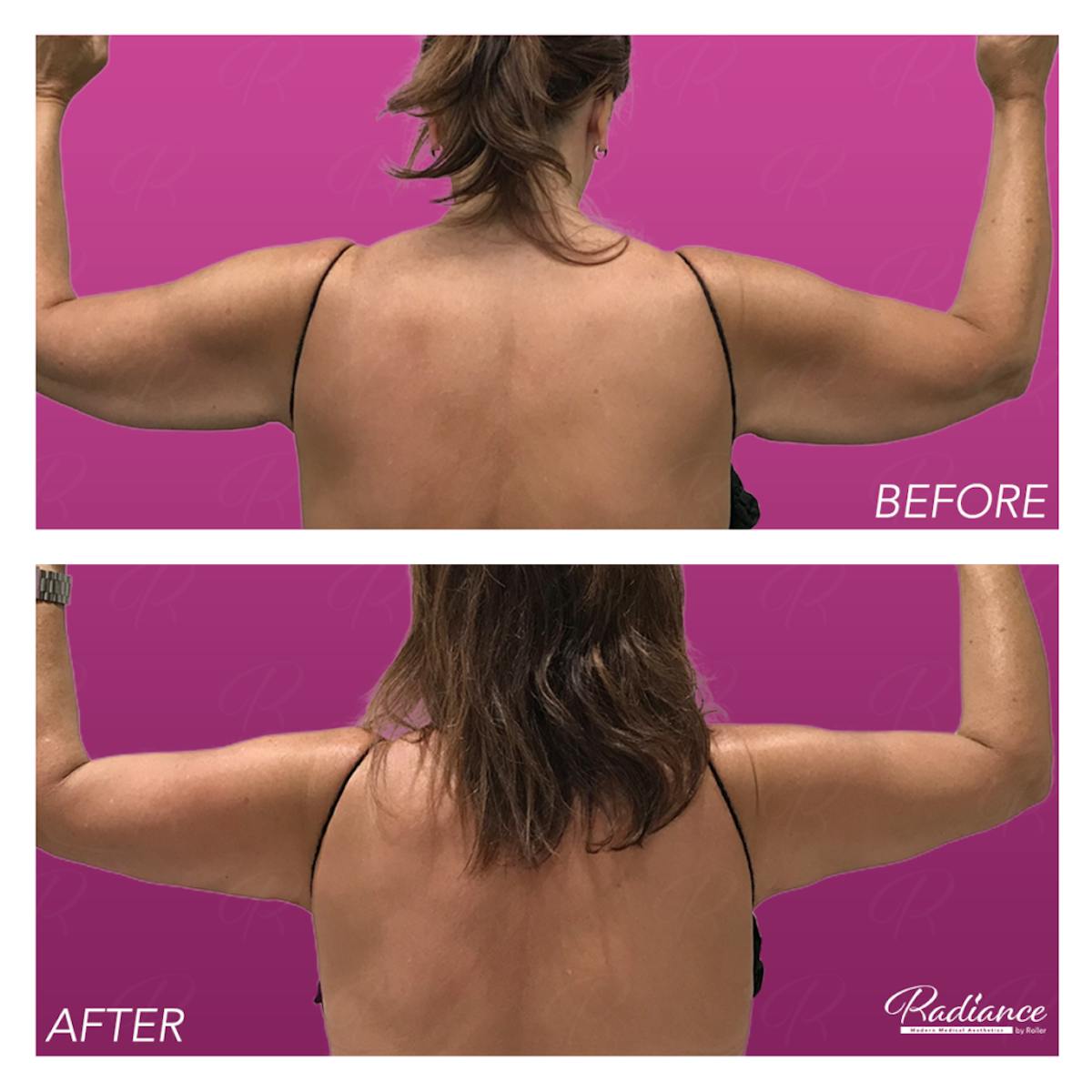 BodyTite Before & After Gallery - Patient 86641396 - Image 1