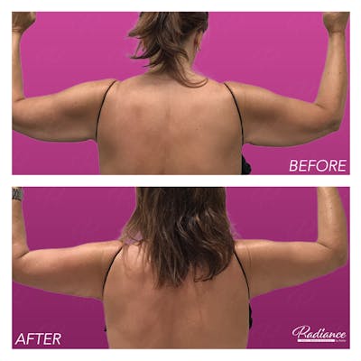 BodyTite Before & After Gallery - Patient 86641396 - Image 1