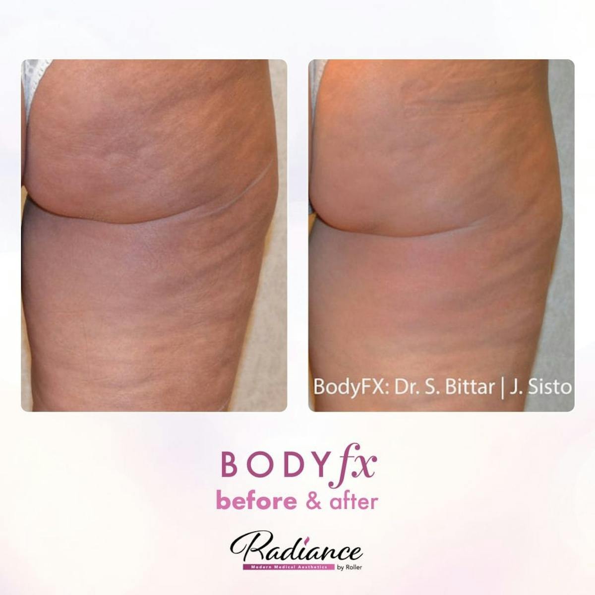 BodyFx Before & After Gallery - Patient 86641394 - Image 1