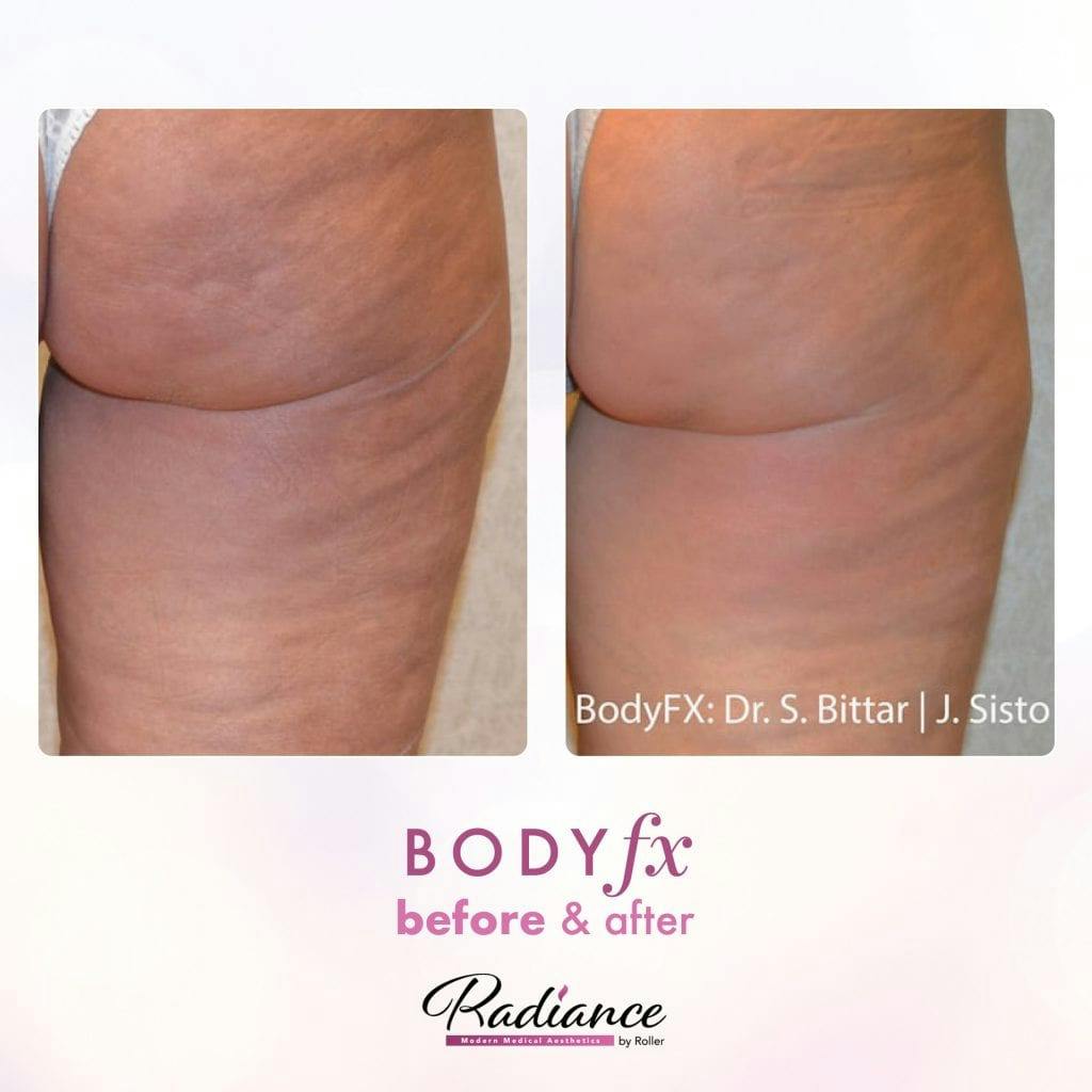 BodyFx Before & After Gallery - Patient 86641394 - Image 1